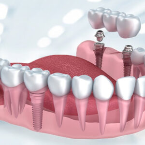 Ablauf der Zahnimplantat Behandlung