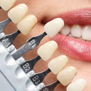 Laminat-Zahnverblendung