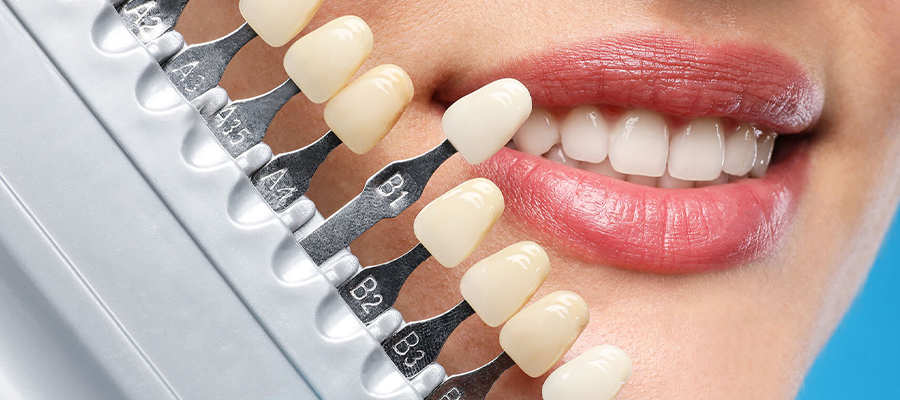 Laminat-Zahnverblendung