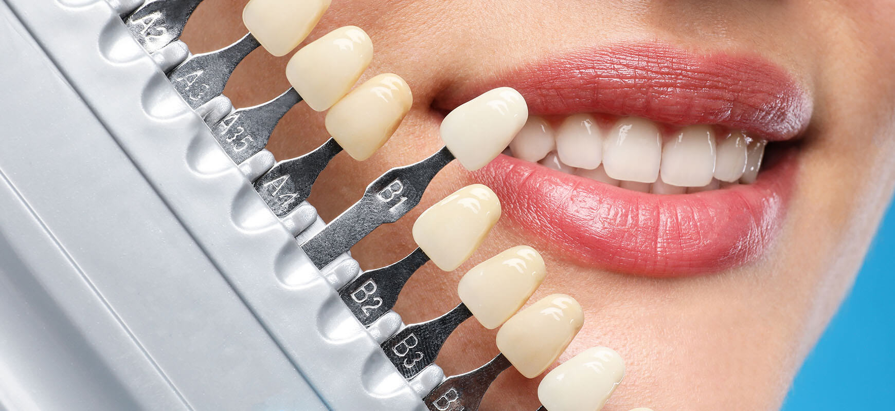 Laminate Dental Veneer