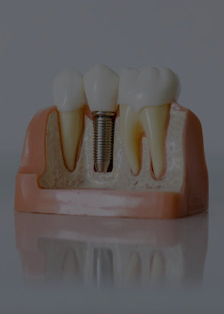 Dental Implant Treatment