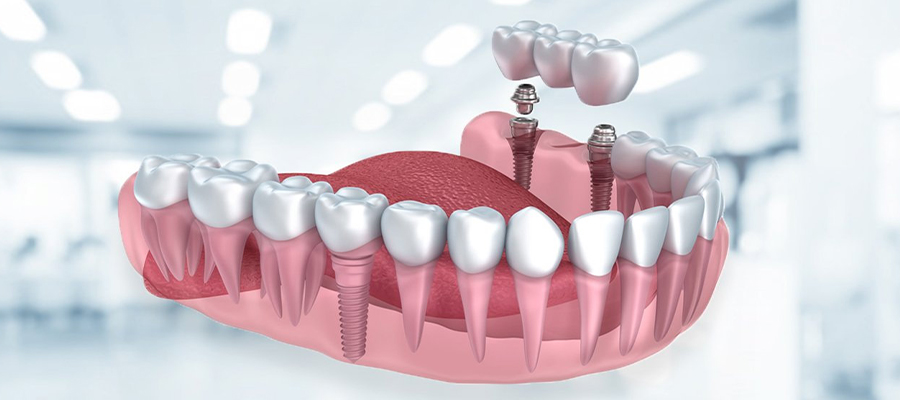 İmplant Diş Tedavisi Süreci